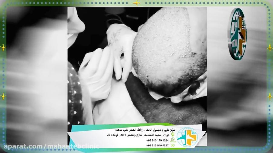 زراعة الشعر مع المرکز التجمیل طب ماهان فی مشهد المقدسة