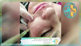 عملیات PRP مع مرکز التجمیل طب ماهان فی مشهد