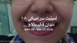 لمینیت سرامیکی اصلاح طرح لبخند اصفهان دکتر محمد عاطفت