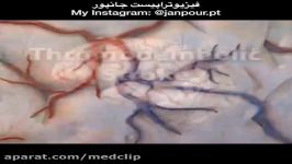 درمان سکته مغزی فیزیوتراپی در منزل،مرکز09122655648مشاور فروش آر تی ام اس،شاک ویو