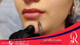 تزریق ژل  فیلم تزریق ژل  کلینیک پوست مو رز  شماره 14