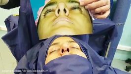 جراحی بینی استخوانی قوز دار، توسط دکتر امید ابراهیمی بهترین جراح بینی