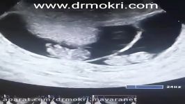 سونوگرافی بارداری دو قلو