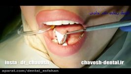 قالب گیری ایمپلنت در اصفهان  ایمپلنت دندان اصفهان  دندانپزشکی زیبایی چاوش