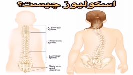 درمان پزشکی اسکولیوز فیزیوتراپی در منزل،مطب تهران09122655648کاردرمانی،ماساژ