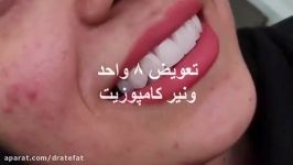 تعویض 8 واحد ونیر کامپوزیتی قدیمی اصلاح طرح لبخند ،اصفهان