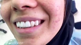 بهترین متخصص دندانپزشکی زیبایی اصفهان درمان کامپوزیت دندان