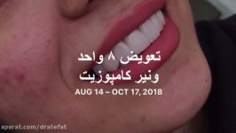 بهترین متخصص زیبایی دندان اصفهان ونیر کامپوزیتی سرامیکی