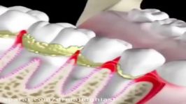 تاثیرات منفی جرم دندان بر دوام دندانها دکترمجیدقیاسی