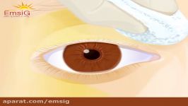 نحوه انجام عمل چشم Lasik