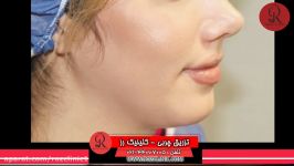 تزریق چربی  فیلم تزریق چربی  کلینیک پوست مو رز  شماره35