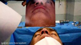 خارج کردن پولیپ بینی در حین عمل زیبایی بینی عمل بینی دکتر ثابتی