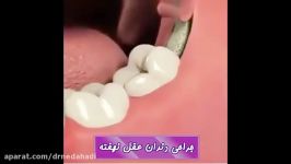 نحوه جراحی دندان عقل نهفته  دکتر ندا هادی جراح دندانپزشک