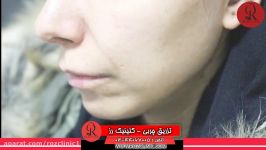 تزریق چربی  فیلم تزریق چربی  کلینیک پوست مو رز  شماره36