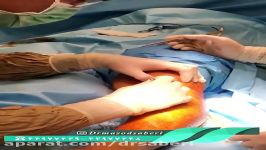 اصلاح زانوی پرانتزی  دکتر مسعود صابری متخصص ارتوپد جراح تعویض مفصل زانو ران