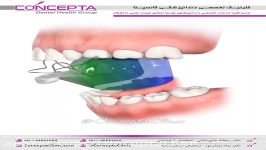 دستگاه ارتودنسی بیوناتور  کلینیک کانسپتا