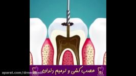 عصب کشی ترمیم دندان  دکتر ندا هادی جراح دندانپزشک زیبایی