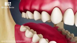 عوارض عدم رعایت بهداشت دهان دندان  دکتر لیلا عطایی