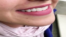 ابتسامة هولیود الفینیر واللومینیر  عیادة الاسنان فی ایران مشهد  كوروش