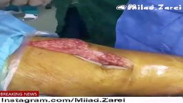 #تعویض #مفصل #زانو #آرتروپلاستی #ارتوپدی √Total knee arthroplasty