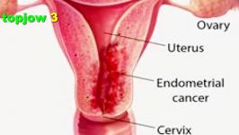 عفونت باکتریال واژن در خانمها Bacterial vaginal infection in women