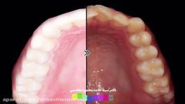 قبل بعد درمان ارتودنسی دندان  دکتر محمودهاشمی متخصص ارتودنسی