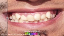 قبل بعد درمان ارتودنسی دندان  دکتر محمودهاشمی متخصص ارتودنسی