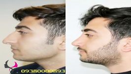 جراحی زیبایی بینی مشهد، 09380000893