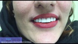 فیلم ونیر دندان  ونیر کامپوزیت در کلینیک دندانپزشکی درسان