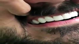 قبل وبعد تجميل الاسنان  اسعار ابتسامة هوليود  ابتسامة هوليود في ایران
