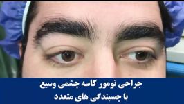 جراحی تومور کاسه چشم وسیع چسبندگی های متعدد