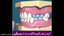 مضرات مکیدن انگشت بعد سه سالگی  دکتر ندا هادی جراح دندانپزشک زیبایی