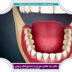 نحوه پر كردن شیار دندان ها  دکتر ندا هادی جراح دندانپزشک زیبایی