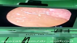 عمل خارج کردن توده داخل مثانه بدون جراحی باز توسط دکتر مهری مهراد