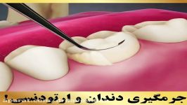 آیا در ارتودنسی امکان جرمگیری وجود دارد؟  دکتر داودیان