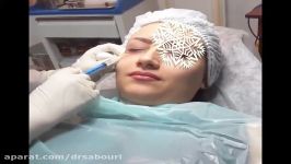 رفع تیرگی زیر چشم مزوتراپی در مطب دکتر صبوری