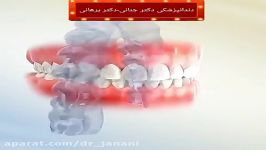 نقش نگهدارنده بعد اتمام درمان ارتودنسی