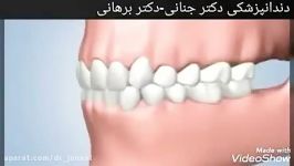 عوارض تحلیل لثه دست رفتن دندان ها