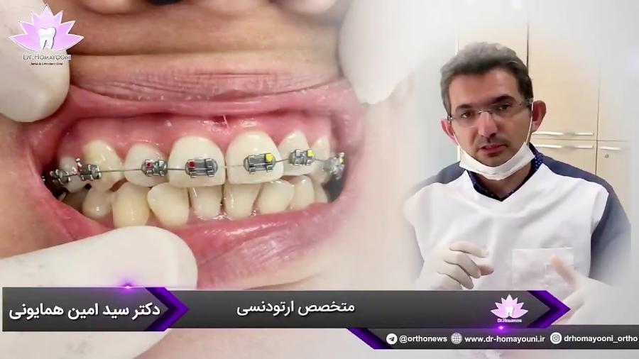 چرا براکت ها در شروع درمان ارتودنسی کج به نظر میرسند؟