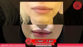 تزریق ژل  فیلم تزریق ژل  کلینیک پوست مو رز  شماره31