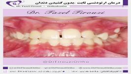 ارتودنسی بدون کشیدن دندان  دکتر فاضل فیروزی