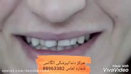 بلیچینگ دندان  سفید کردن دندان  کاشت نگین دندان  بروساژ دندان  جرمگیری دندان