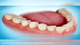 نحوه مرتب سازی دندان توسط ارتودنسی  دکتر محمودهاشمی متخصص ارتودنسی
