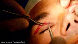 جراحی پلک عمل جراحی بینی به صورت همزمان دکتر کسری ثابتی