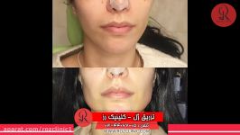 تزریق ژل  فیلم تزریق ژل  کلینیک پوست مو رز  شماره34