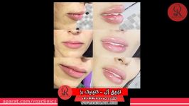 تزریق ژل  فیلم تزریق ژل  کلینیک پوست مو رز  شماره35