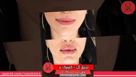 تزریق ژل  فیلم تزریق ژل  کلینیک پوست مو رز  شماره36