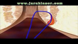 درمان فیستول لیزر  کلینیک مهنا
