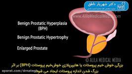 درمان بزرگی پروستات  دکتر شهریار ناطق