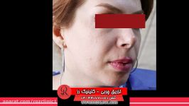 تزریق چربی  فیلم تزریق چربی  کلینیک پوست مو رز  شماره43